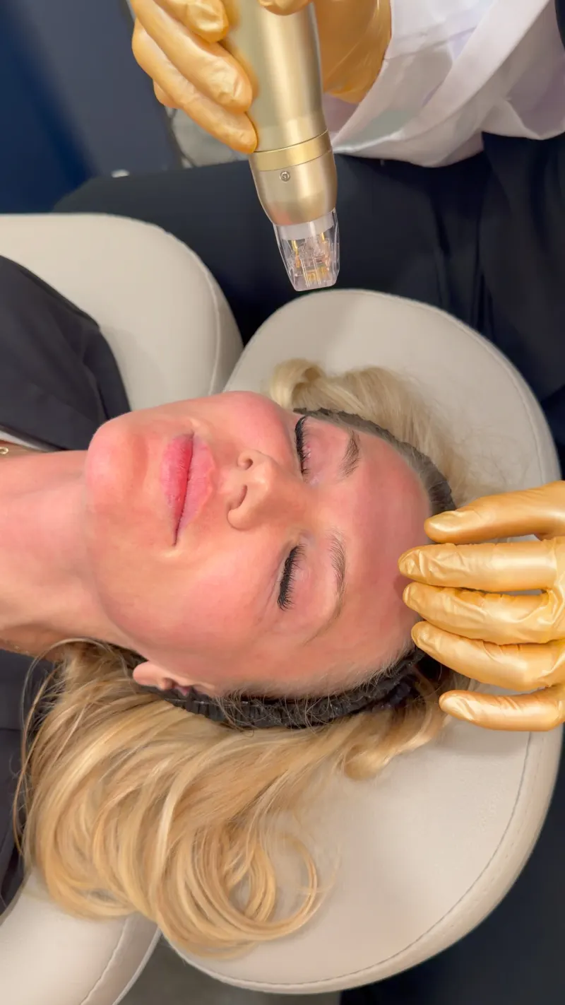 Skin Tightening & RF Microneedling