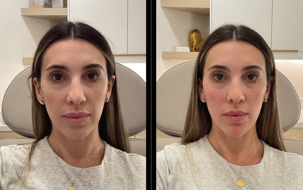 ✨ The Art of Natural Filler ✨ by RN Jordanne 💕
Enhancing — not changing — your beauty 🤍
At Call of Beauty, filler isn’t about “bigger.”
It’s about balance, support & anatomical precision.
Think of filler like scaffolding for the face:
It quietly restores lost structure, lift & youthful contours —
without ever looking “done.”
🔬 Our Technique Focuses On:
• Supporting deep anatomical foundations
• Replacing volume only where it’s truly needed
• Harmonizing facial proportions (not forcing fullness)
• Sculpting soft, elegant, undetectable results
✨ When your results whisper luxury — not shout “filler” —
that’s when beauty becomes art.
Natural. Refreshed. Elevated.
Never overfilled. Always you — enhanced. 💉🤍
⸻
👉 Ready to age gracefully, not drastically?
Book your consultation and experience the Call of Beauty difference 🤍
Website: CallofBeautyMedSpa.com
Call: 760-230-2211