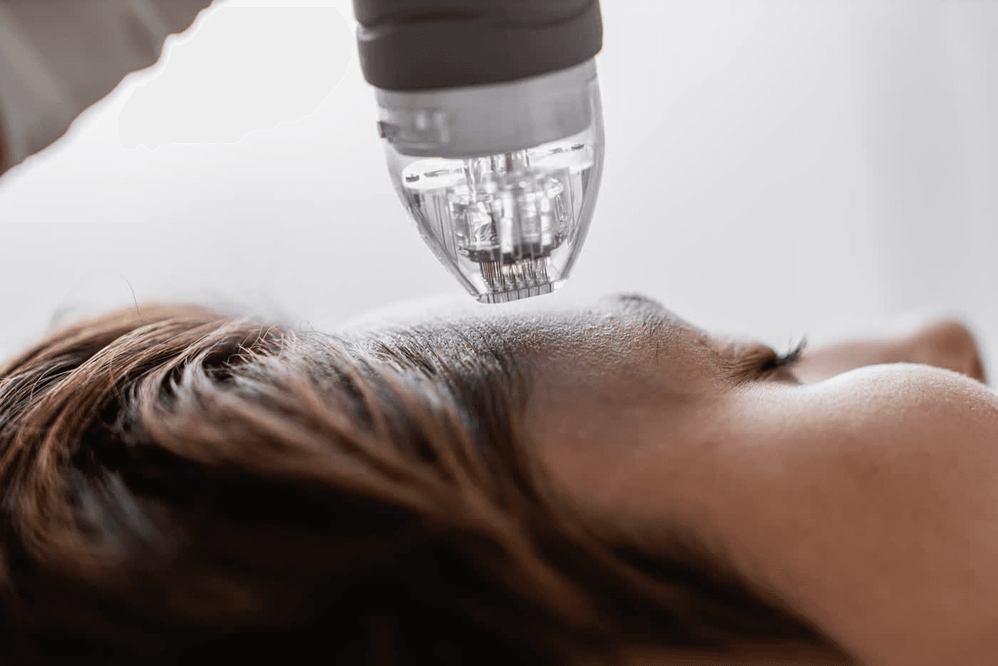 SylfirmX microneedling session targeting jawline