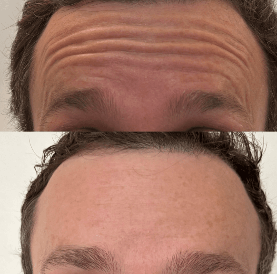 Brotox in Encinitas: The No-BS Guide to Botox for Men